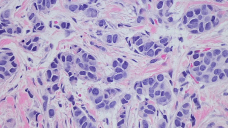 Estrogen dominance and breast cancer prevention: A Functional Nutrition approach